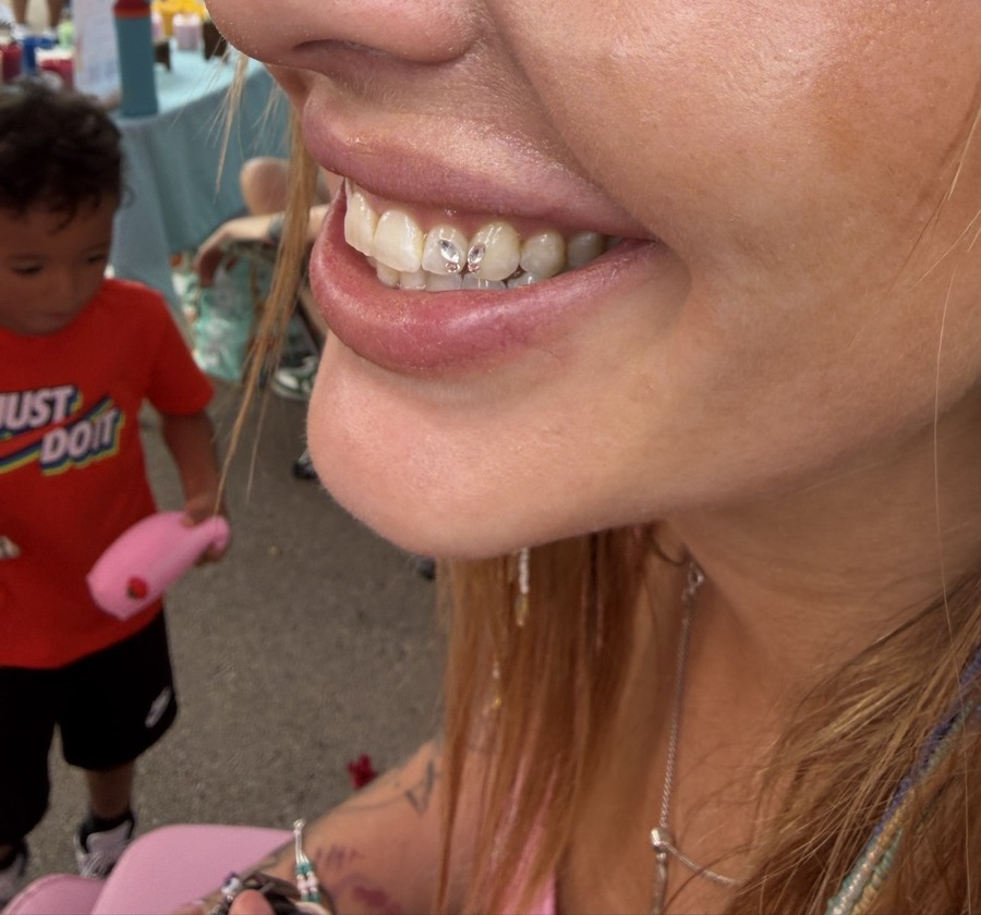 Tooth gem example