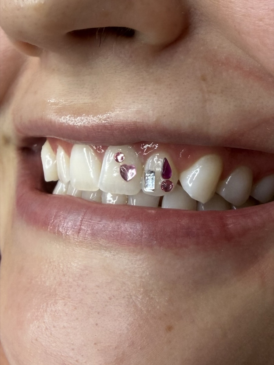 Tooth gem example